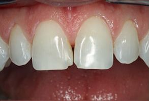 Mywisdom Dental | Ceramic Crowns, Dental Bridges and ViziLite reg 